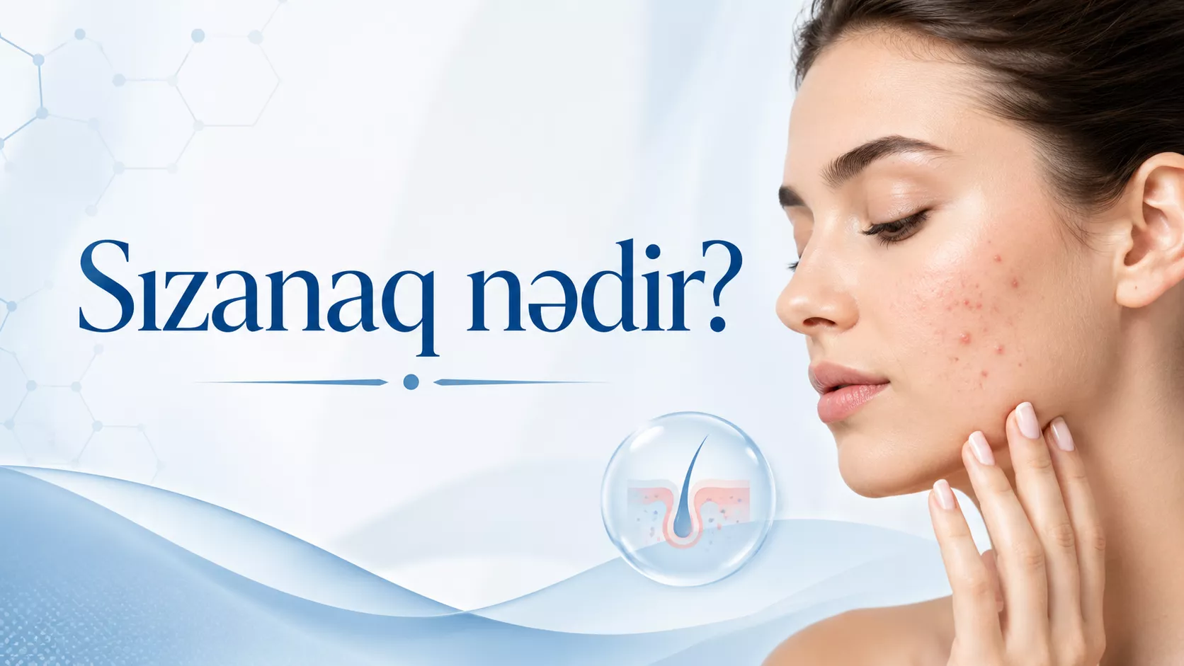 Sızanaq nədir? Sızanaq xəstəliyi və sızanaq müalicəsi